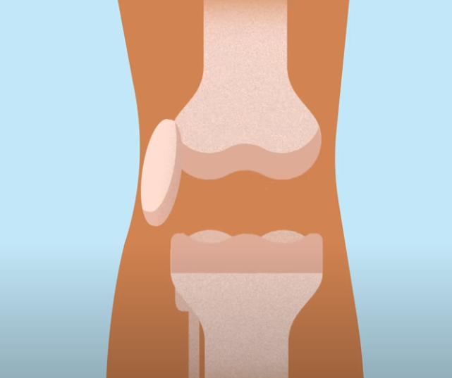 무릎 인공관절 수술 정보와 주의사항